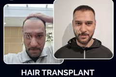 hairtransplantturkey