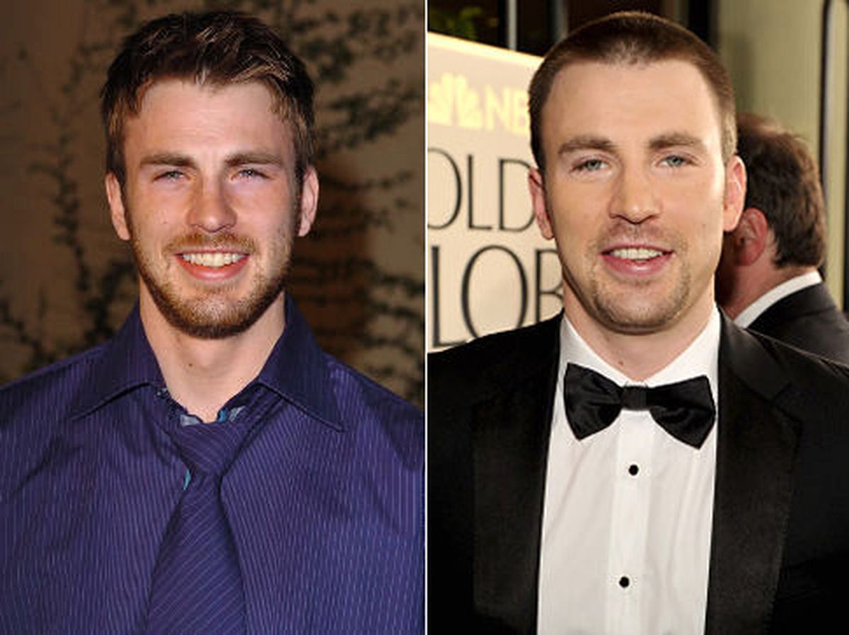 Chris Evans Hair Transplant Sapphire Hair Clinic