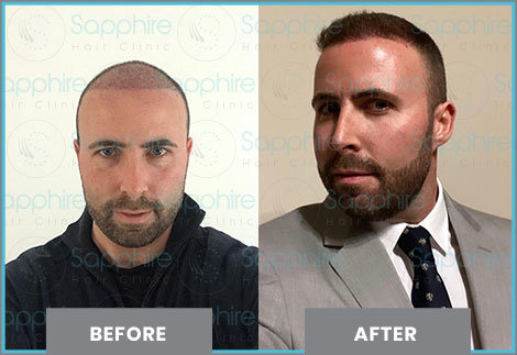 Before and After Hair Transplant Turkey - AEK Hair Clinic